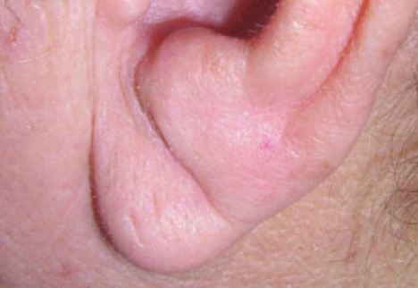 складка на мочке уха
